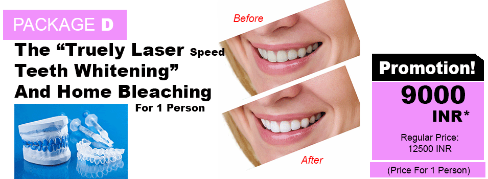Home Teeth Whitening