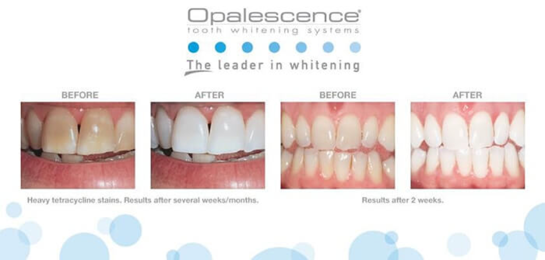 Opalescence отбеливание 40. Отбеливание зубов Opalescence Boost. Отбеливание Opalescence Boost до и после. Химическое отбеливание Opalescence Boost.