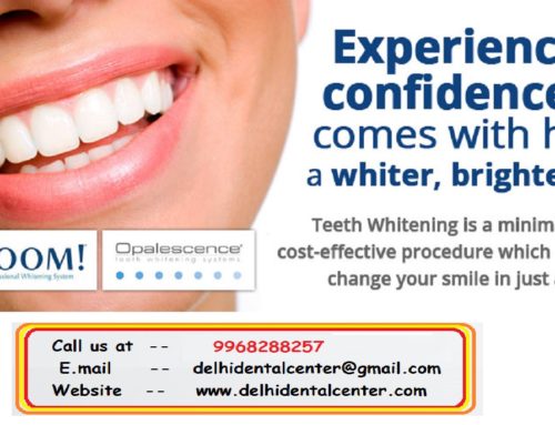Tooth whitening Clinic in Delhi