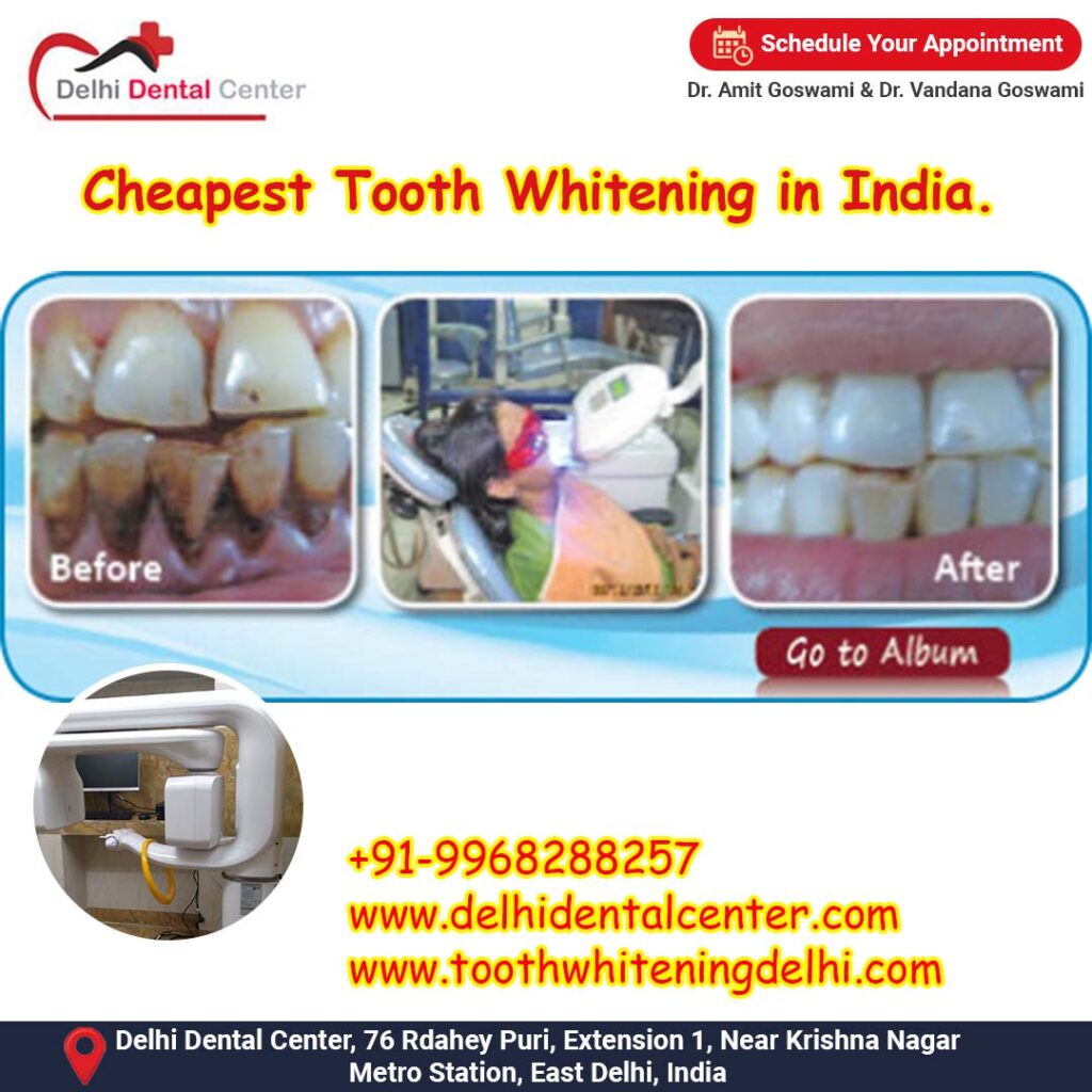 Best Top Teeth Whitening, Tooth Whitening Treatment, Tooth whitening dental clinic in India