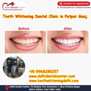 Tooth Whitening Dental Clinic in Patpar Ganj